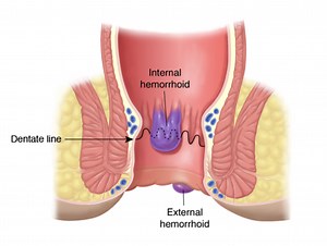 Hemorrhoid Treatment and Classification