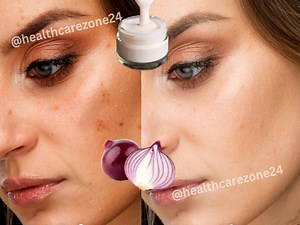 8M views · 88K reactions | 100 year old recipe - an old woman is 60 years old she Wipe her spots with onion mask #glowingskin #AntiAging | Health Care Zone | Facebook