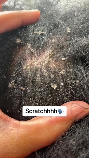#dandruff #dandruffremovel #dandruffscratching #flakesbythepound #fyp #foryou
