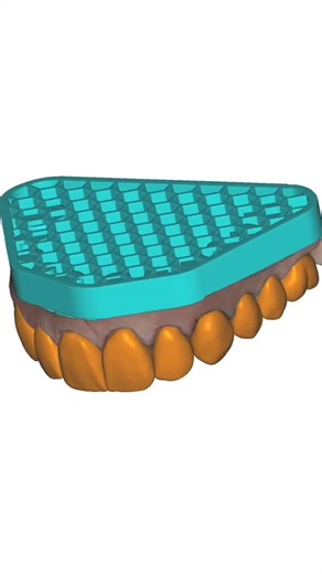 🅳🅴🅽🆃🅰🅻 🆃🅴🅲🅷🅽🅸🅲🅸🅰🅽 on Instagram: "@dr.allanqueiroz —— 🚨 Zirconia Veneers 💥 Yes, zirconia! 🤓 And yes, they bond! 🔥 Game Changing ● ultra-thin case—just 200 microns thick, milled from Argen ST. Still confused about the cementation protocol? 😬 Still unsure about how to design and finish? Time to level up.🤓 🚀 Join us this November in Charleston for the NEXT Veneers Residency with Dr. Wally Renne, Dr. Casey Bennett & myself — a fully immersive, hands-on weekend covering: • No-pr