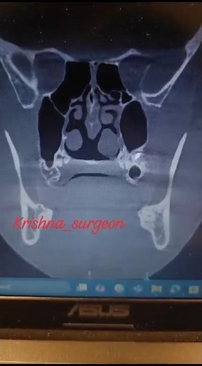 Dentigerous cyst irt 28 involving the Maxillary sinus #pathology #bestsurgeon #maxillofacialsurgeon