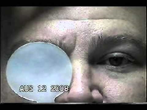 Vertical Skew Deviation