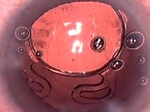 Insertion Technique for Akreos IOLs - Eyetube