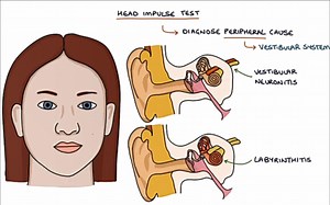 【搬运】头脉冲试验（HIT）