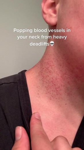 Burst Blood Vessels in Neck: Causes and Effects