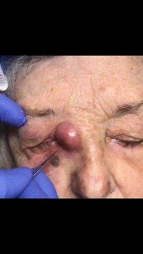 Pimple Content⚠️ on Instagram: "Post your reaction below ▶️  . . . . . #pimplepopping #pimplepoppingvideos #pimpleproblems #pimplesremover #pimplefree #pimplemarks #pimplespamore #pimpleremoval #pimplecure #pimpleskin #blackheads #darkcircles #dryskin #whiteheads #pores #oilyskin #acneskin #blackheadremoval #skintype #skintherapist #blemishes #nowrinkles #undereyecircles #antiwrinkles #crowsfeet #wrinklefree #hyaluronicacid #nomorewrinkles #skinceuticals #cosmeticdermatology"