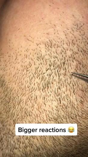79K views · 210 reactions | Transform Your Look Instantly!  Watch Our Ultimate Mustache Removal Guide Using Tweezers for a Smooth Finished #mustacheremoval | April-09-04 | Facebook