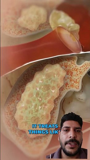 Tympanomastoidectomy surgery (कान से पस या पानी आना )#EarInfection #Tympanomastoidectomy #EarCare