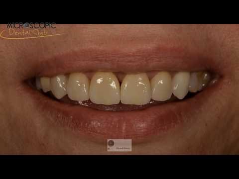 Laminate veneers from preparation to cementation