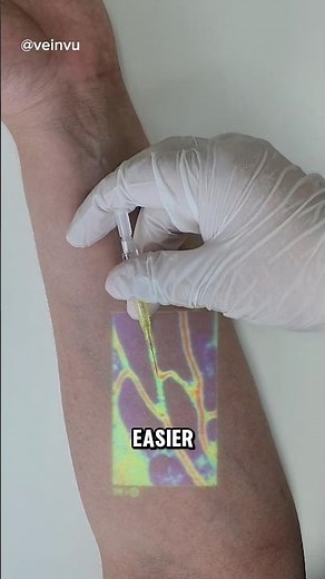 Revolutionary Vein Finder for Easier IV Access!