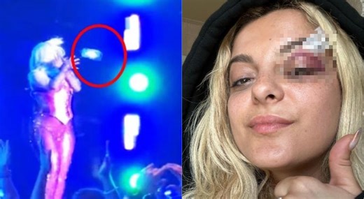 Golpearon con celular a Bebe Rexha y así le dejaron el ojo🎦