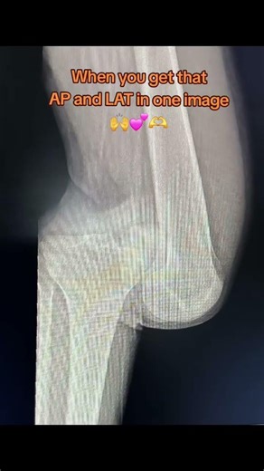 knee x ray in Ap Lateral view in one image #orthopedics #bone