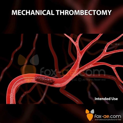 Mechanical Thrombectomy