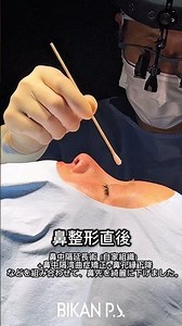 【拘縮鼻】拘縮でアップノーズになりすぎた？