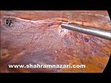 Laparoscopic Bilateral Direct Hernia • Video • MEDtube.net