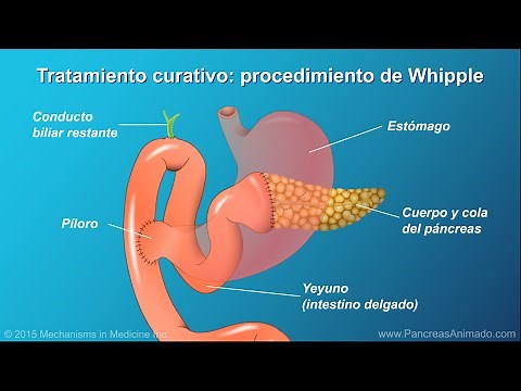 Cáncer de páncreas: tratamiento y resultados