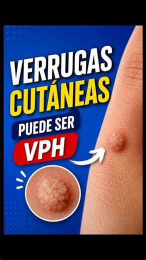 ¿Tienes verrugas en la piel? Podrían ser causadas por el Virus del Papiloma Humano