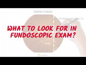 What to look for in fundoscopic exam Neuroaholics