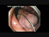 Colonoscopy Goes Awry - Cecal EMR Bleed - clip B • Video • MEDtube.net