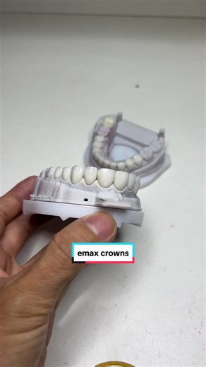 Emax Crowns: Enhance Your Smile with Quality Dental Solutions