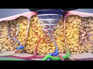 Permanent Non-Surgical Body Fat Reduction Procedure