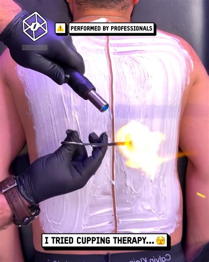 I went for cupping therapy - and it wasn't what I expected 😯🔥 | UNILAD