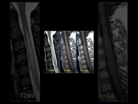 Estudio de la patología infecciosa en columna