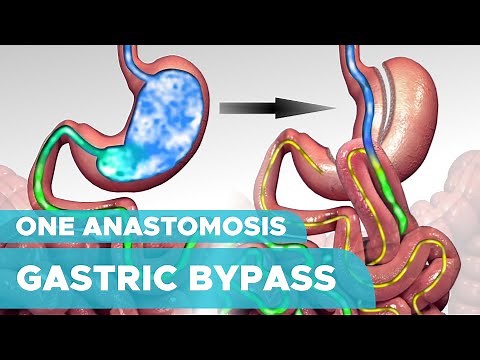 Types of Weight Loss Surgery: One Anastomosis Gastric Bypass Surgery (OAGB)
