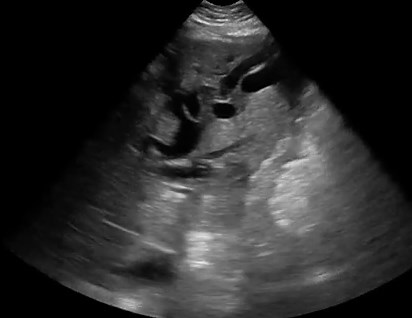 Intrahepatic Biliary Duct Dilation