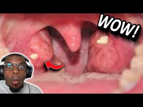 MASSIVE TONSIL STONE POPS!