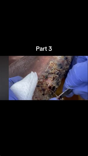 #jiggers #digging #asmr #relaxing