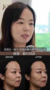 其實你不是老，是皮膚變鬆 ｜ 鳳凰電波 紫鑽探頭 全面臉部緊實 + 膚質提升｜ 琢禾美學診所 國際原廠講師 示範案例