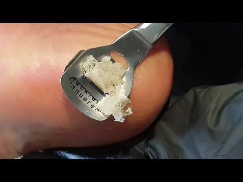 Pedicure ( Pedicure At Home DIY Hard Dead Skin Removal )
