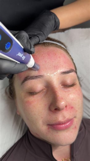 Achieve Glass Skin with Microneedling Techniques