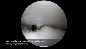 Remplissage Technique: Basic Step by Step