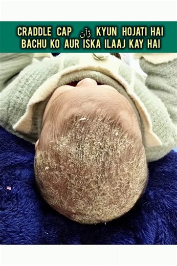 Craddle cap aur #dandruff mai hair oil kyun nahi lagana chahiye? Full video link in comment...