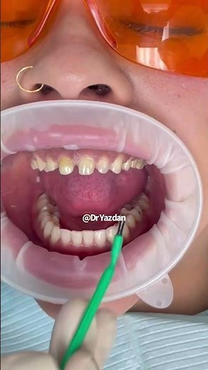 Porcelain veneers procedure | dental veneers procedure step by step | smile makeover | Dr. Yazdan
