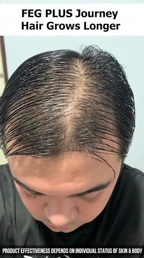‏Remove balding hair with #fegplus #hairgrowthserum
