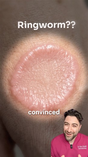 People Mistake This for Ringworm All The Time…