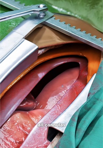 Aortic Valve Replacement Surgery Explained in 3D