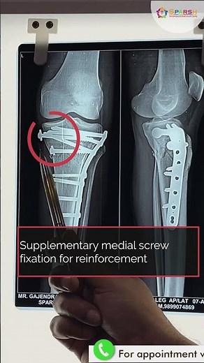 Proximal Third Tibia Fracture Management #drankitbhartia #proximal3rdtibiafracture