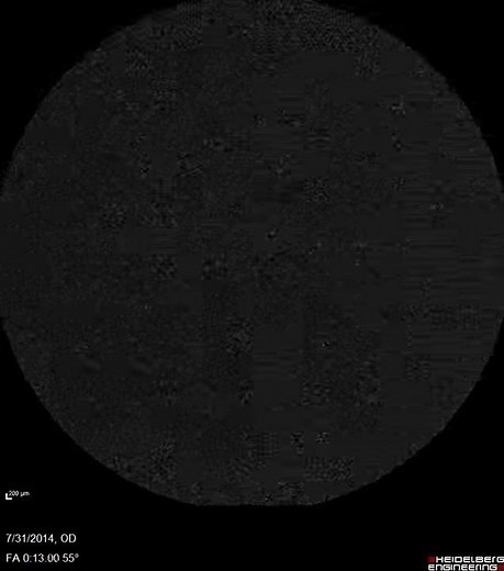 Central Retinal Vein Occlusion