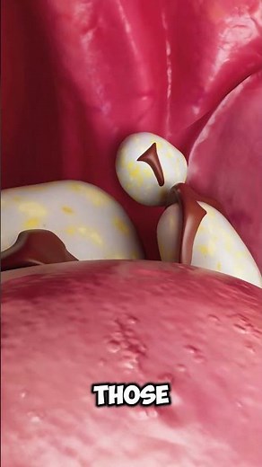 What Causes Tonsil Stones?
