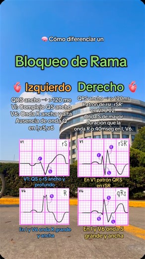 Alejandro Sánchez Cervantes on Instagram: "🧠🫀 En este video te explicamos los bloqueos de rama derecho e izquierdo en un electrocardiograma (ECG). Aprenderás cómo identificar las características clave de cada uno y su importancia clínica en el diagnóstico de problemas cardíacos. ¡No te lo pierdas! #doctor #dr #medico #medicina #doctores #cardiologia"