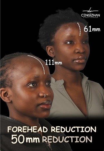 Forehead Reduction: The C Reduction Technique Explained
