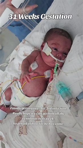 Inspiring Journey of a 22-Week NICU Baby