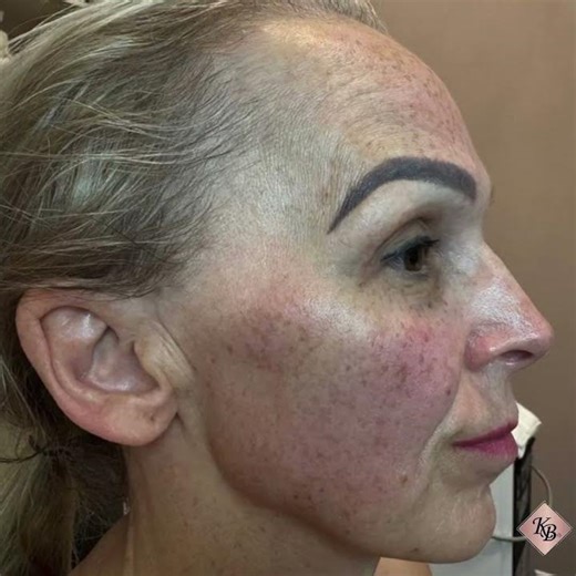 Xerf Before After - Glamour by Krystal Beauty