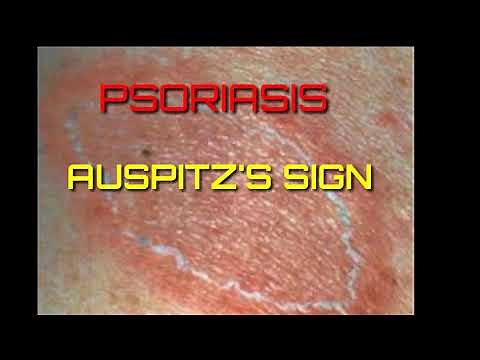 Auspitz's sign demonstration||Grattage test||psoriasis