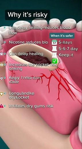 😬 Zyn after a tooth extraction? High risk for dry socket.