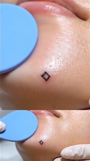 Chin Area Pore Smoothing — Silicone Scraper & Gentle Vacuum ASMR